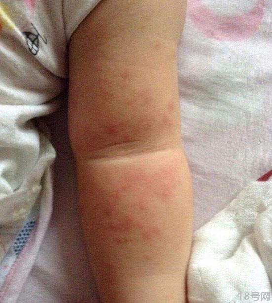 过敏性湿疹有哪些特点?