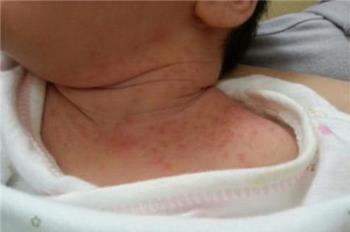 宝宝湿疹是怎么引起的 宝宝湿疹的5大因素