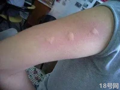 蚊子包如何快速消肿止痒？这些方法效果好