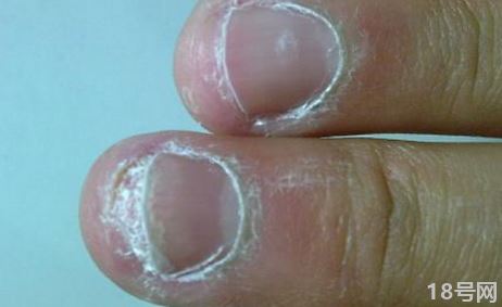 灰指甲要刮多薄指甲才能涂药2