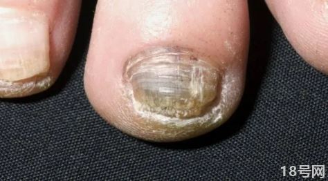 脚上灰指甲的危害性有多严重3