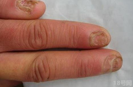 灰指甲最开始的症状会发脓吗2