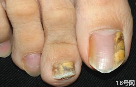 灰指甲最开始的症状会发脓吗3