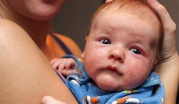 婴儿湿疹最佳治疗方法 护理湿疹的注意事项
