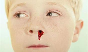 孩子流鼻血是怎么回事 哪些因素导致孩子流鼻血