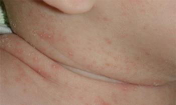 痱子症状图片 痱子和湿疹的区别