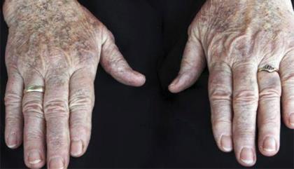 老年斑是怎么形成的 老年斑的形成原因