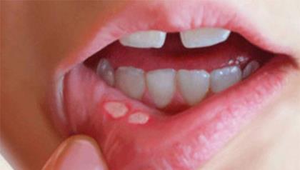口干舌燥是什么原因 口干舌燥是怎么引起的