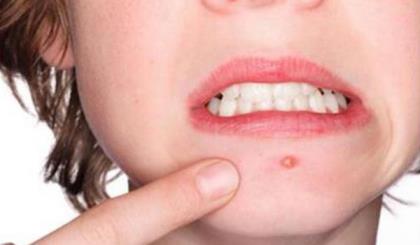 嘴巴周围长痘的原因 什么因素引起嘴巴周围长痘