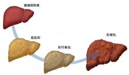 什么是脂肪肝 哪些人群容易得脂肪肝