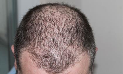秃顶的原因 日常如何预防秃顶发生