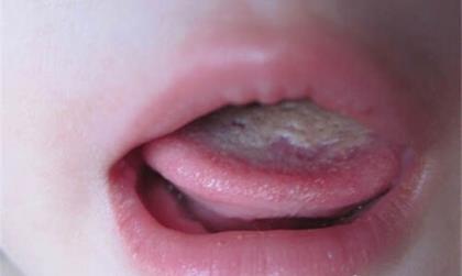 婴儿舌苔厚白是怎么回事 婴儿舌苔厚白怎么去除