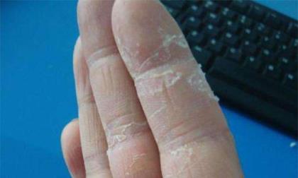 手指脱皮是什么原因 引起手指脱皮的常见原因