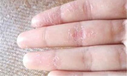 手指脱皮是什么原因 引起手指脱皮的常见原因