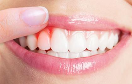 日常如何预防牙齿出血 牙齿出血是