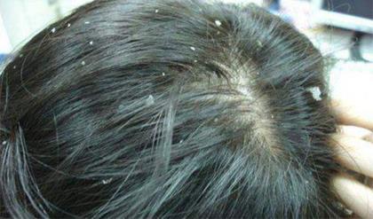 头皮屑多是什么原因 什么原因导致头皮屑增多