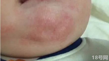 小儿有过敏性湿疹是什么原因造成的？